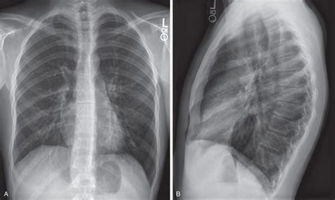 can chest xray show asthma|Asthma Imaging and Diagnosis .